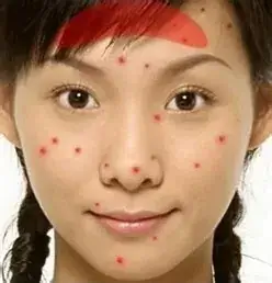 What Causes Acne On The Forehead