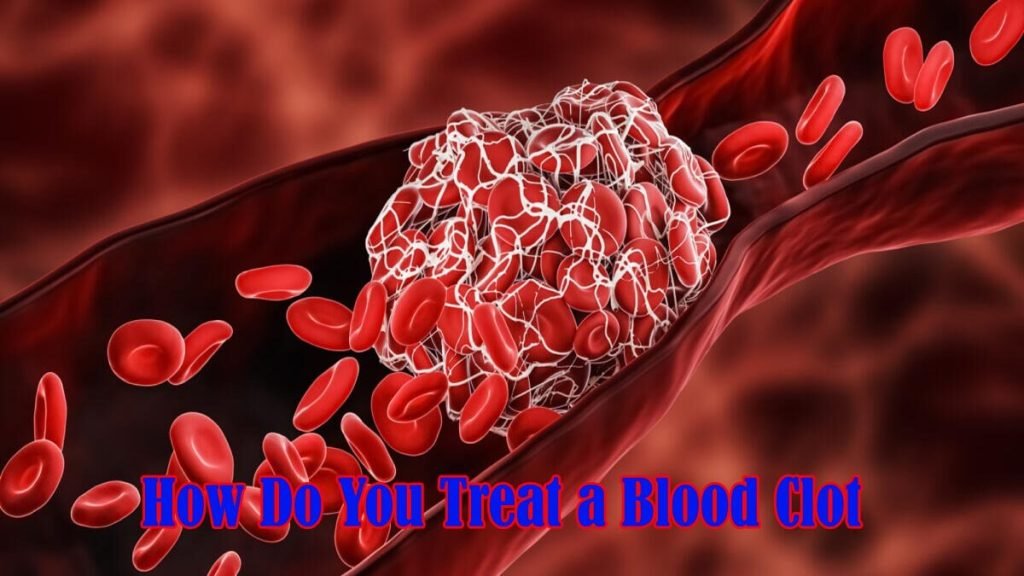 How Do You Treat a Blood Clot