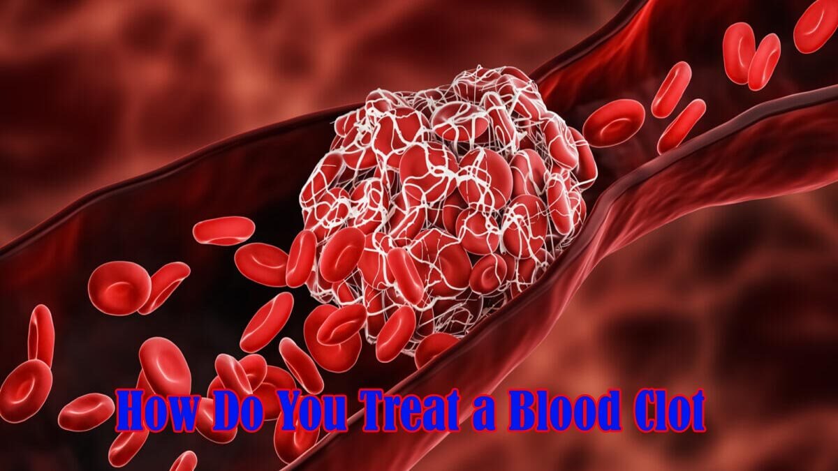 How Do You Treat A Blood Clot?