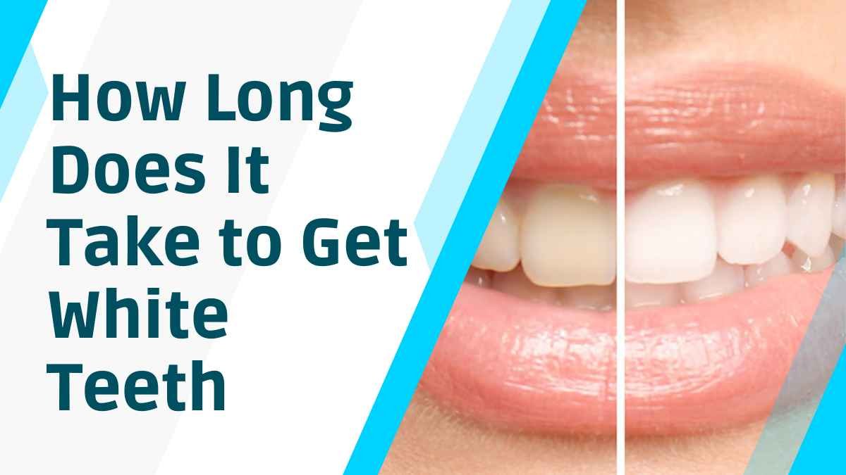 How Long Does It Take to Get White Teeth: A Comprehensive Guide in 2023