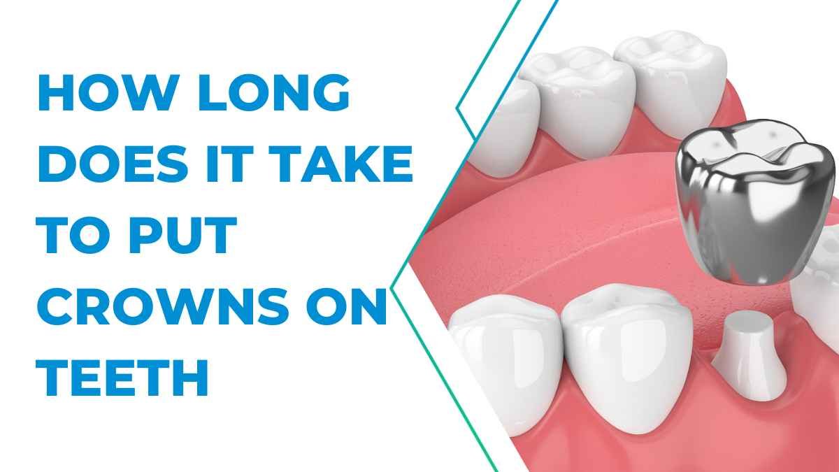 How Long Does It Take to Put Crowns on Teeth: A Comprehensive Guide in 2023