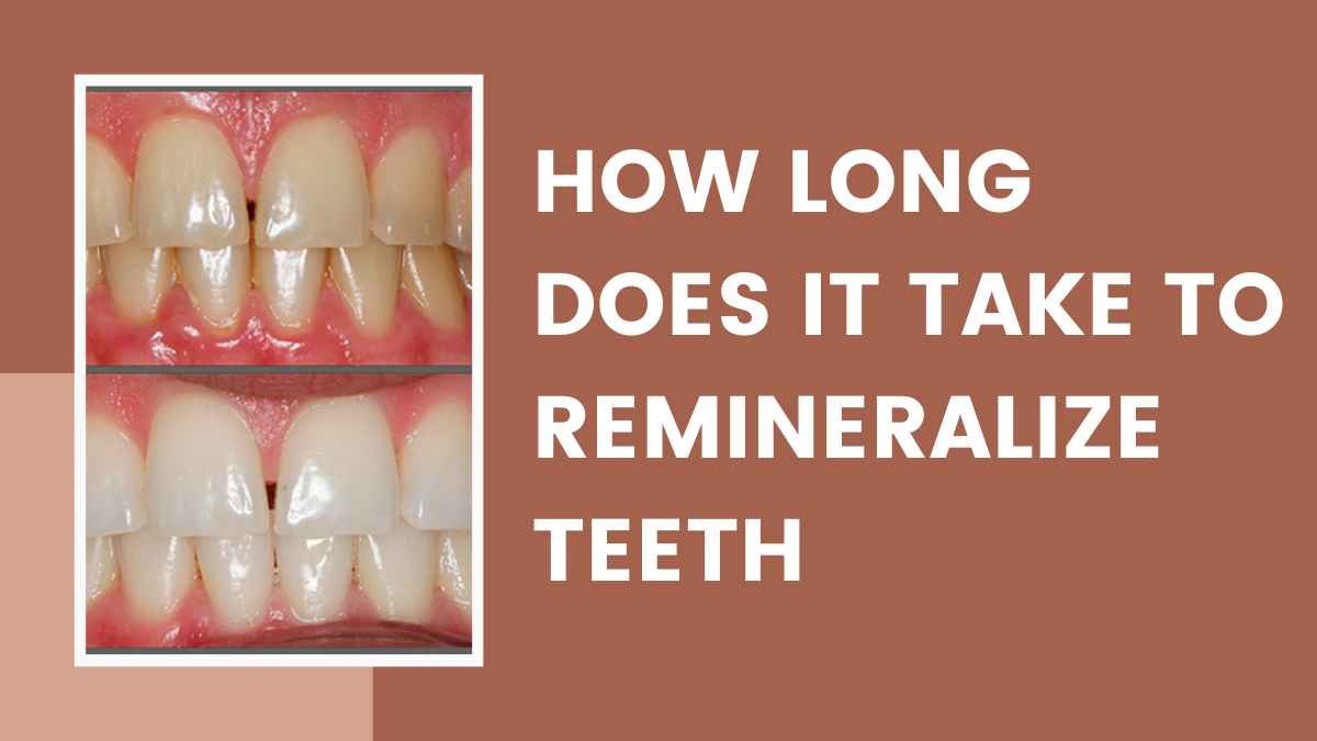 How Long Does It Take to Remineralize Teeth: A Comprehensive Guide in 2023