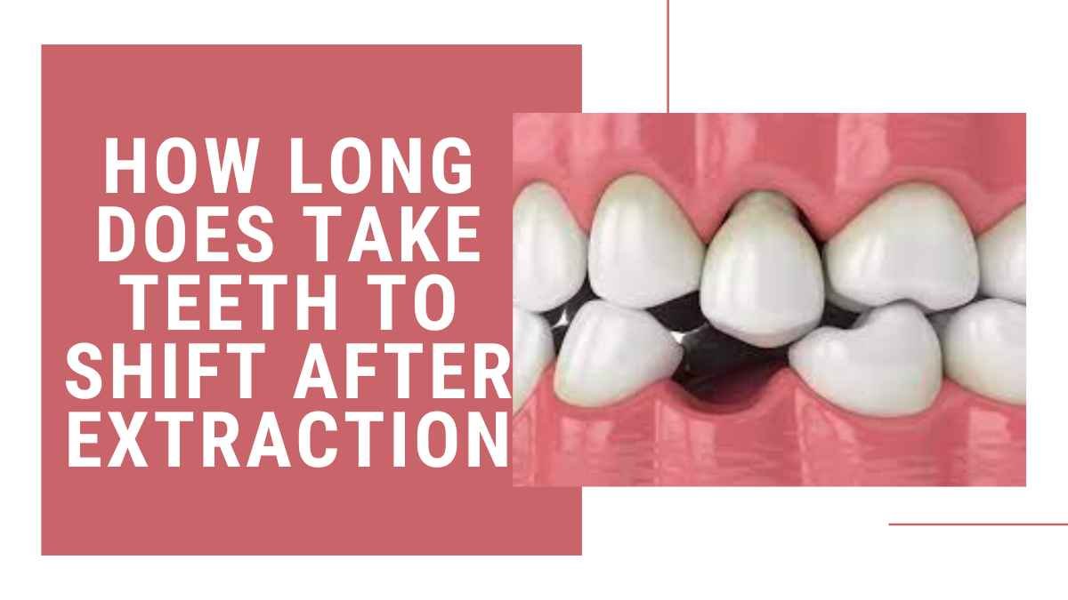 How Long Does Take Teeth to Shift After Extraction? A Comprehensive Guide 2023