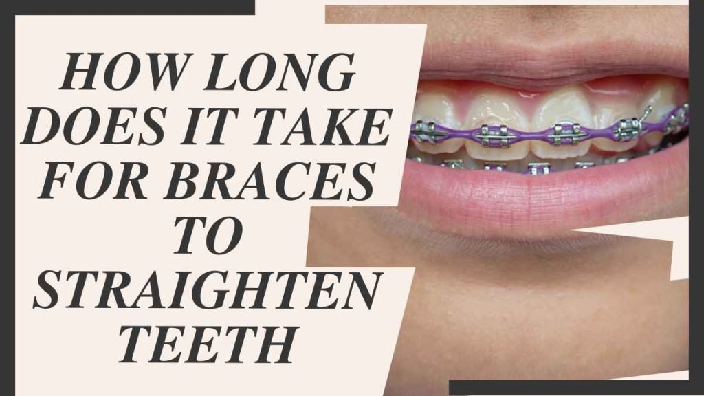 How Long Does it Take for Braces to Straighten Teeth