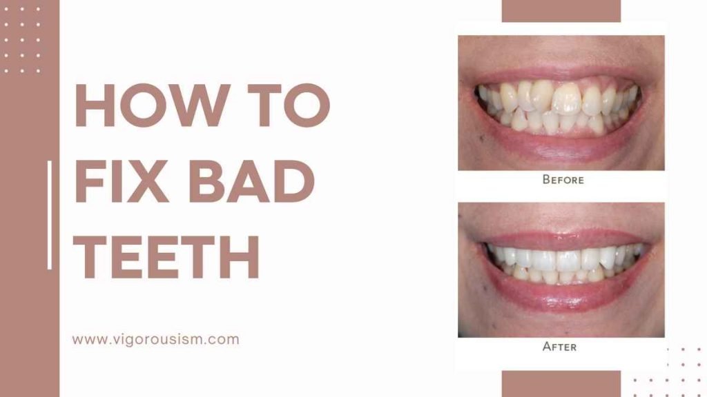 How to Fix Bad Teeth