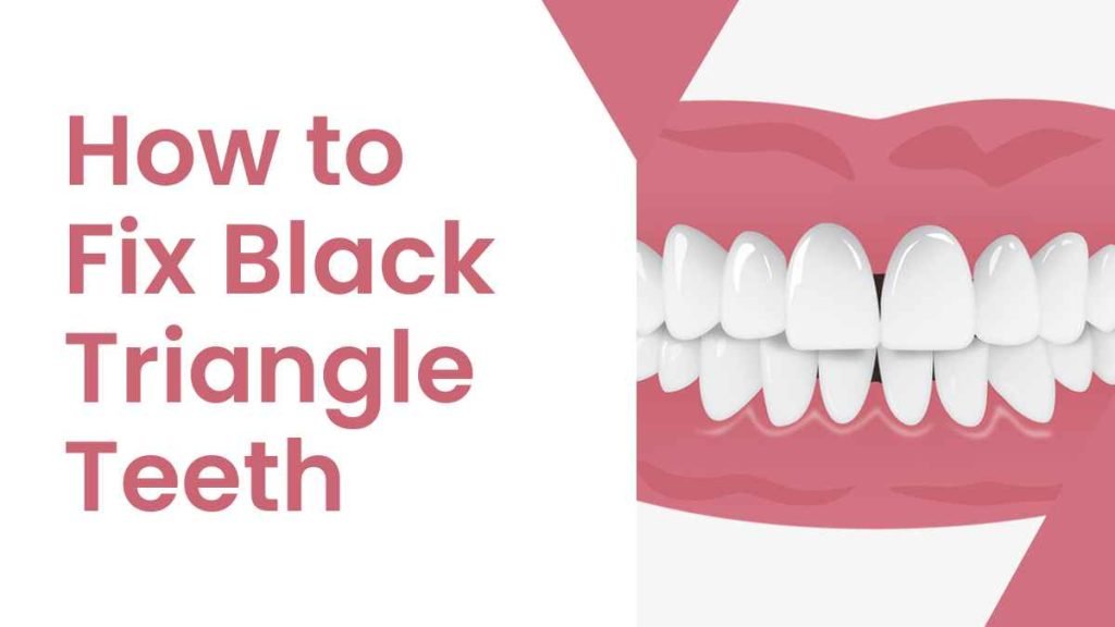 How to Fix Black Triangle Teeth