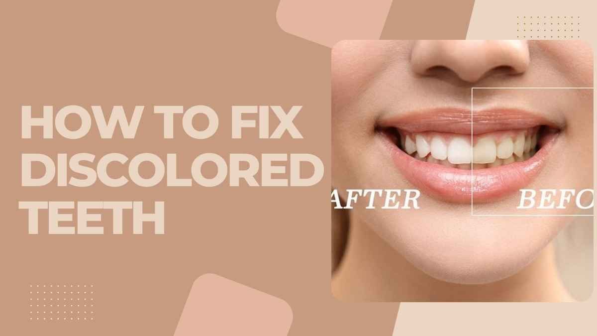 How to Fix Discolored Teeth: A Comprehensive Guide in 2023