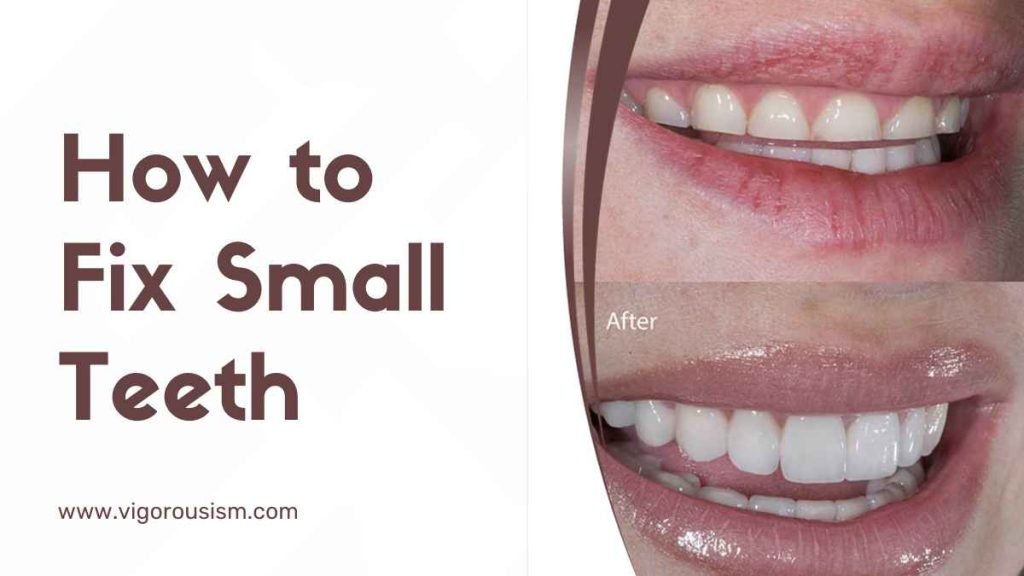 How to Fix Small Teeth