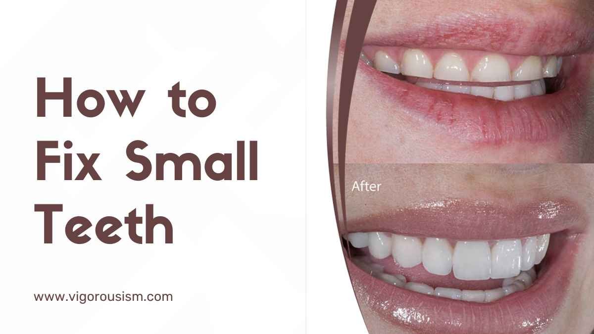 How to Fix Small Teeth: A Comprehensive Guide in 2023