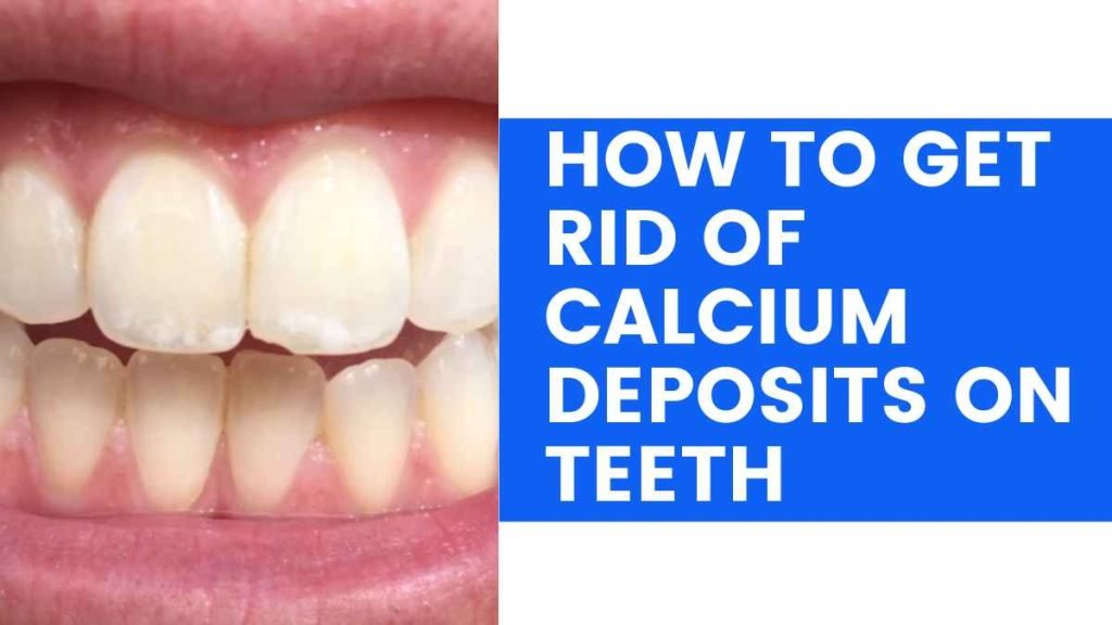 How to Get Rid of Calcium Deposits on Teeth