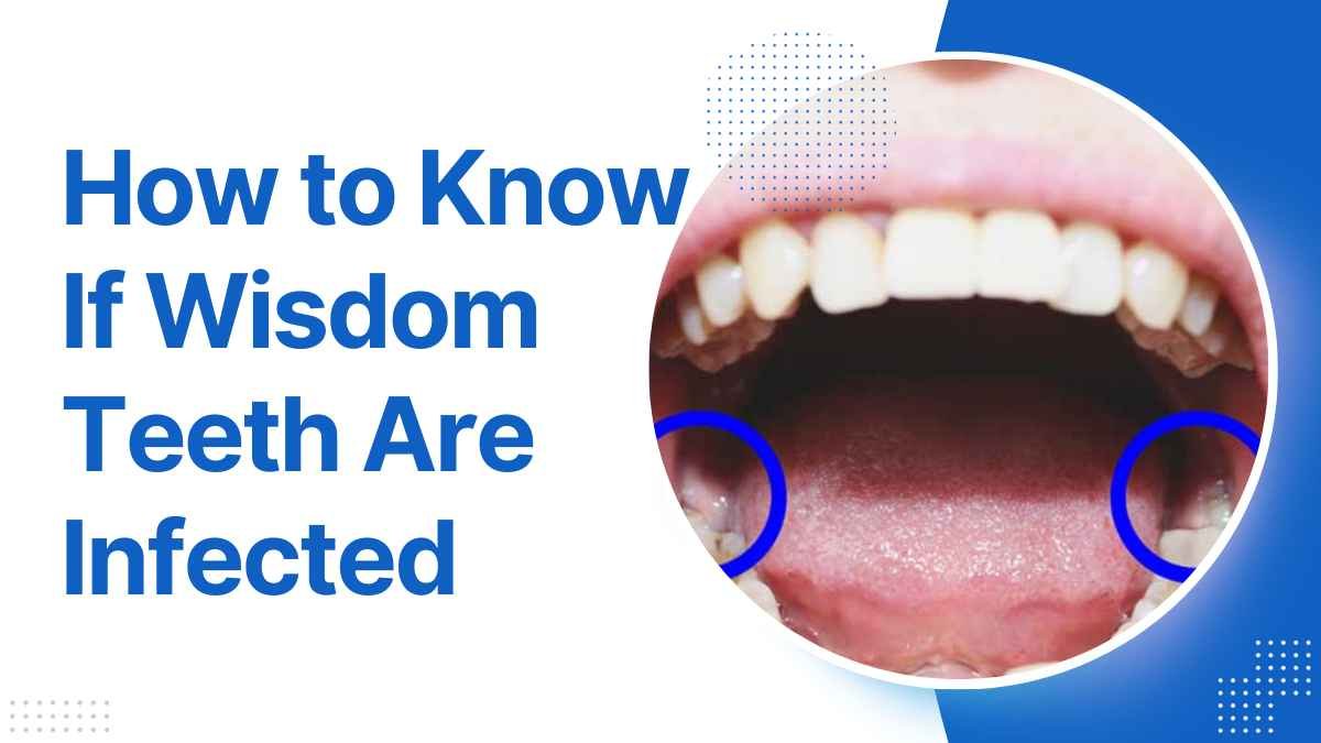 How to Know If Wisdom Teeth Are Infected: A Comprehensive Guide in 2023