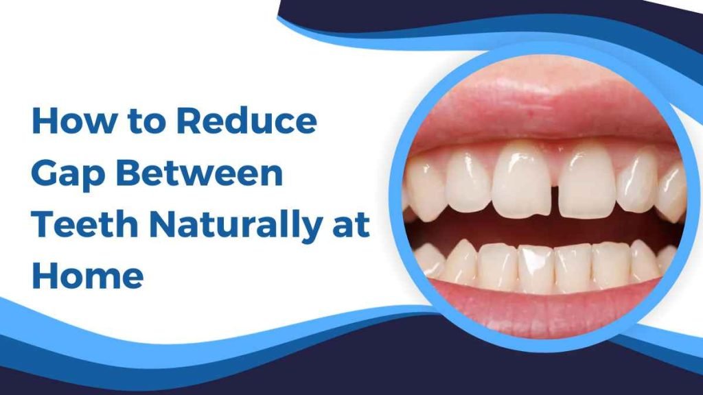 How to Reduce Gap Between Teeth Naturally at Home