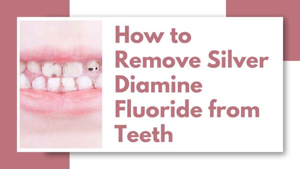 How to Remove Silver Diamine Fluoride from Teeth