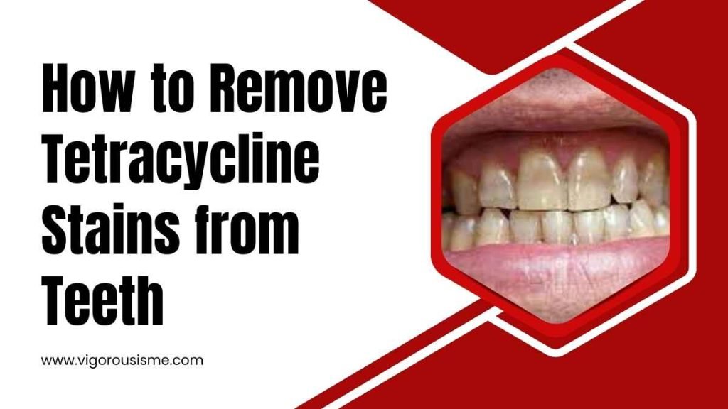 How to Remove Tetracycline Stains from Teeth