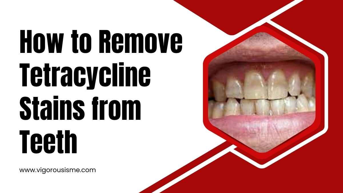 How to Remove Tetracycline Stains from Teeth: A Comprehensive Guide in 2023