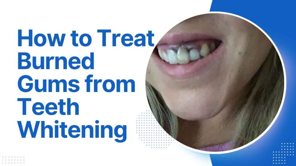 How to Treat Burned Gums from Teeth Whitening