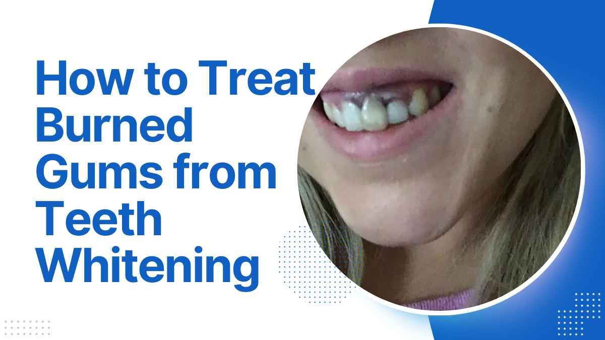 How to Treat Burned Gums from Teeth Whitening: A Comprehensive Guide in 2023