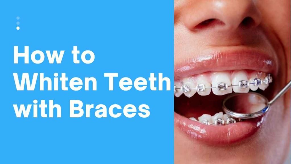 How to Whiten Teeth with Braces