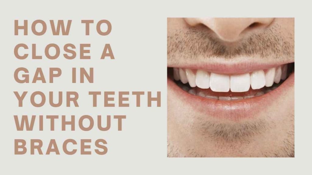 How to Close a Gap in Your Teeth Without Braces