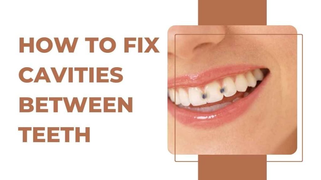 How to Fix Cavities Between Teeth