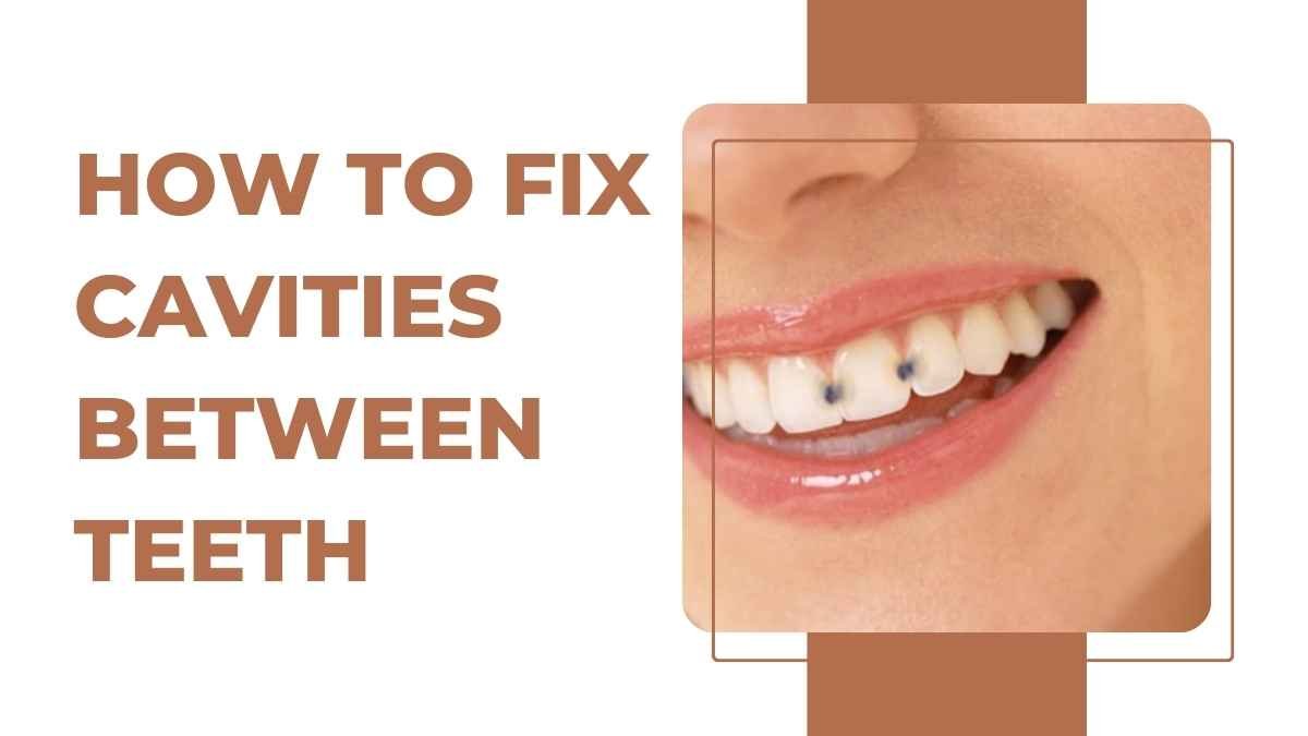 How to Fix Cavities Between Teeth: A Comprehensive Guide in 2023